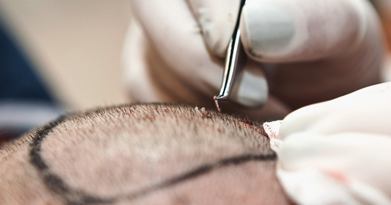 Investigating the most important factors influencing the hair transplant cost in Istanbul