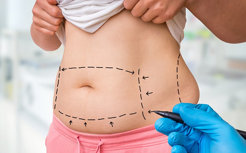 liposuction cost in Istanbul