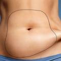 Why should we do liposuction before weight loss?